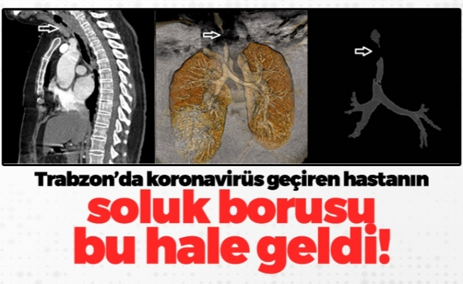 Trabzon'da koronavirüs geçiren hastanın soluk borusunda 4,5 cm'lik sorun